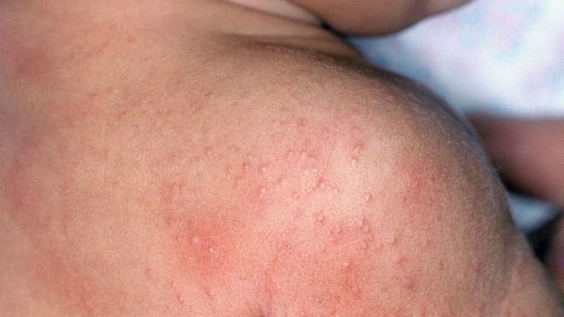 Trị rôm sảy cho bé